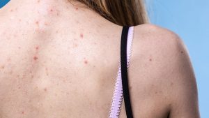 how to treat back acne 722x406 1